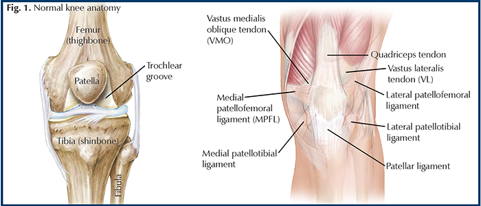 traumatic-patellar-dislocation-georgia