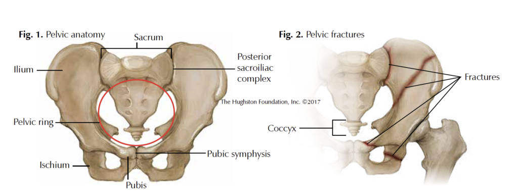 pelvic-fractures-georgia