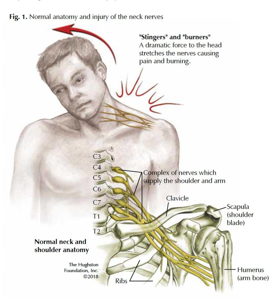 Neck Pain That Radiates To Chest