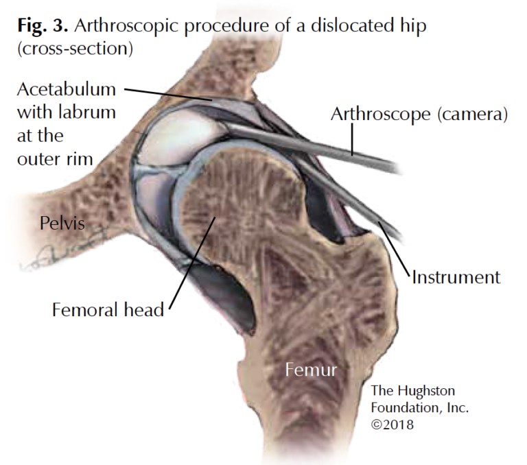 Hip Arthroscopy Georgia 7378