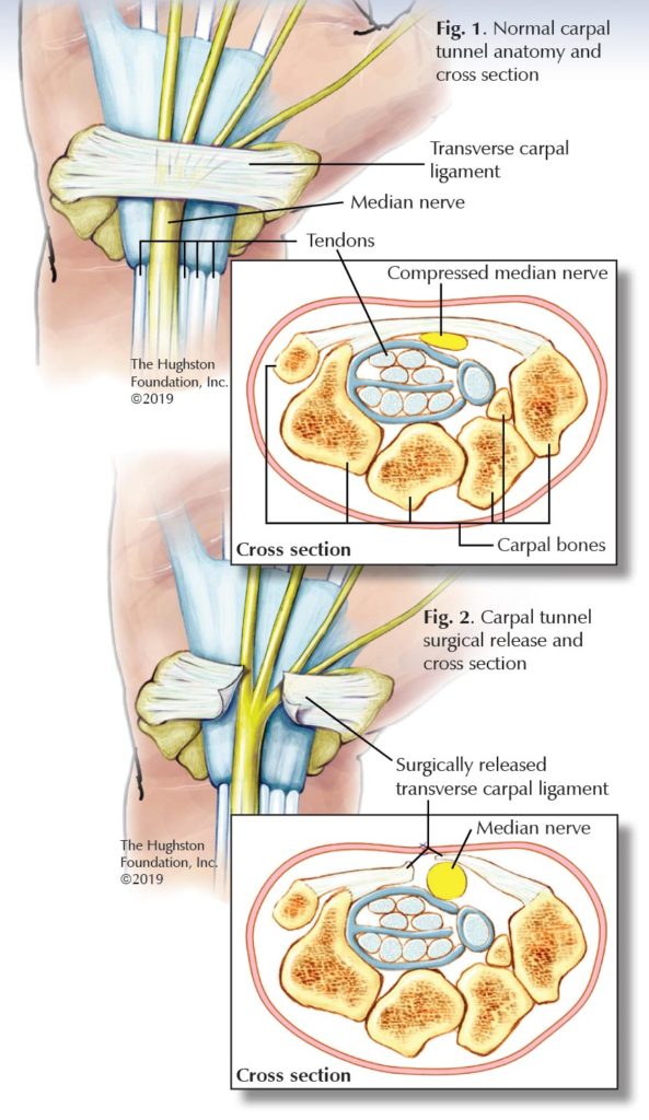 carpal-tunnel-syndrome-questions-for-a-specialist-georgia