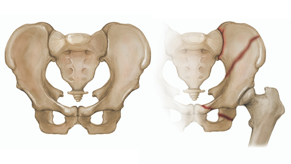 Can A Fractured Pelvis Heal Without Surgery