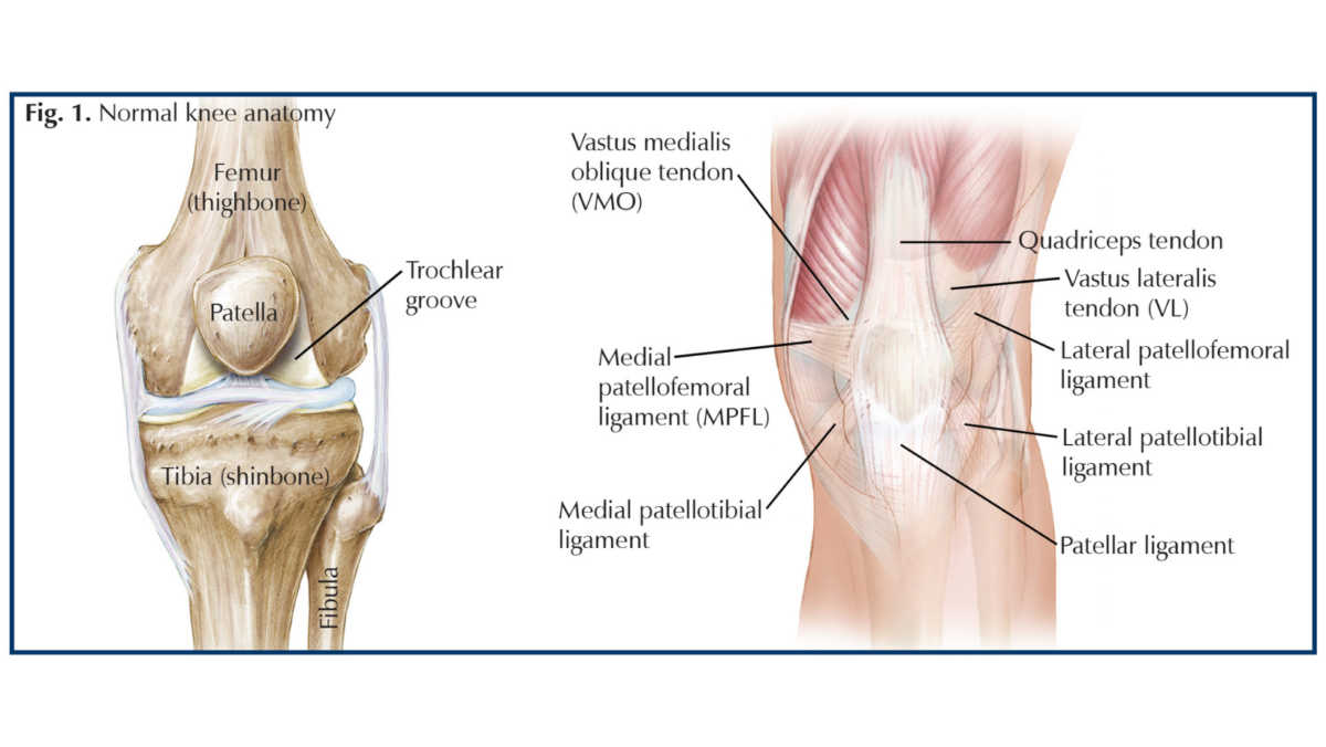 Traumatic Patellar Dislocation Georgia