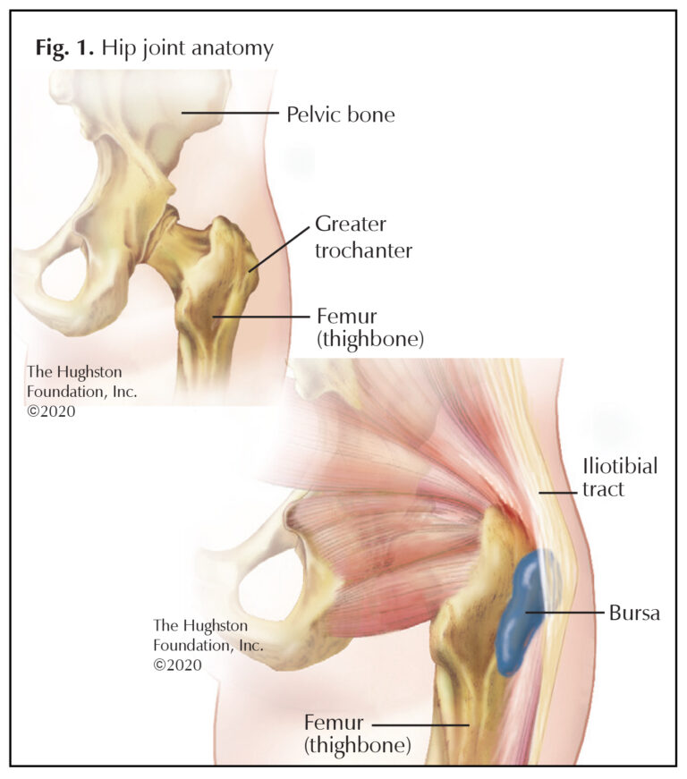 Greater Trochanteric Bursitis A Common Cause of Hip Pain