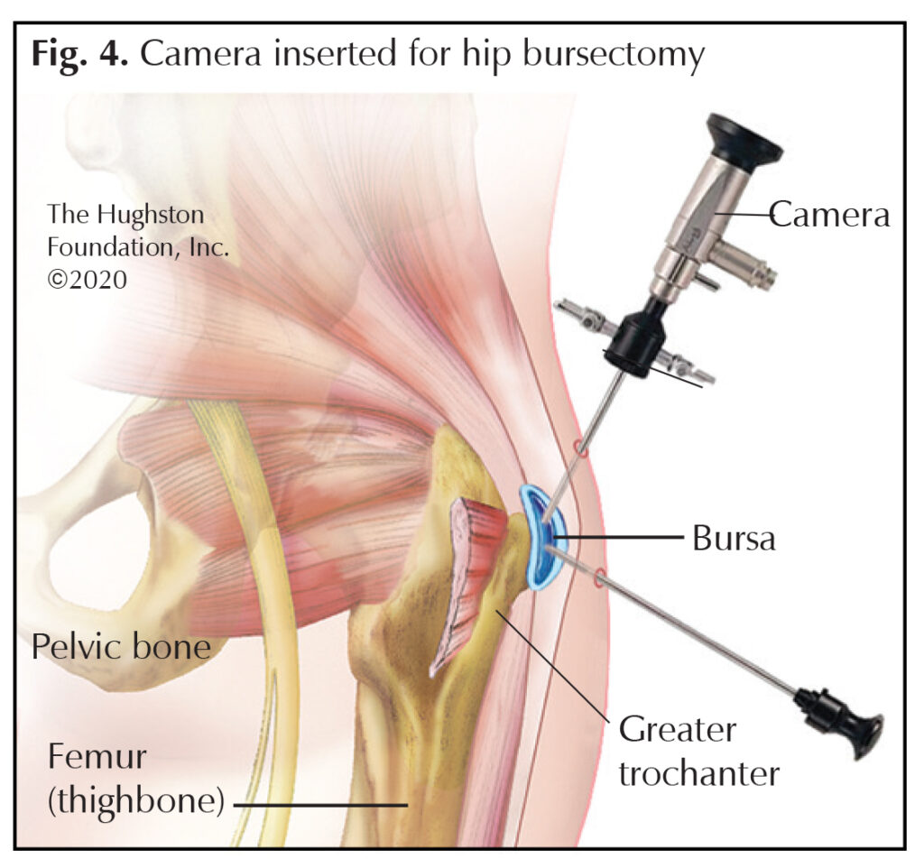 Greater Trochanteric Bursitis A Common Cause of Hip Pain