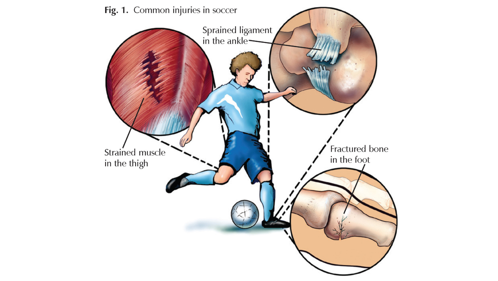 Soccer Players: Sprains, Strains, and Breaks