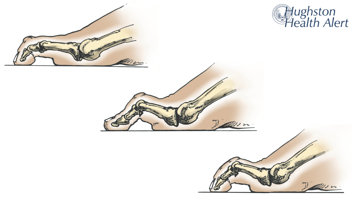 Lesser Toe Deformities: Understanding Claw Toe, Hammer Toe, and Mallet Toe